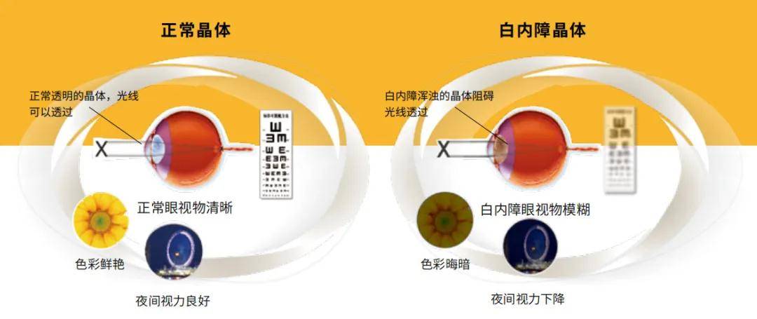 玻璃體混濁最新特效藥，突破與創(chuàng)新的治療策略